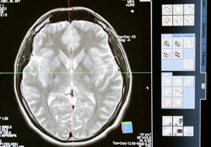 Scan of brain injury for National Winter Sports Awareness